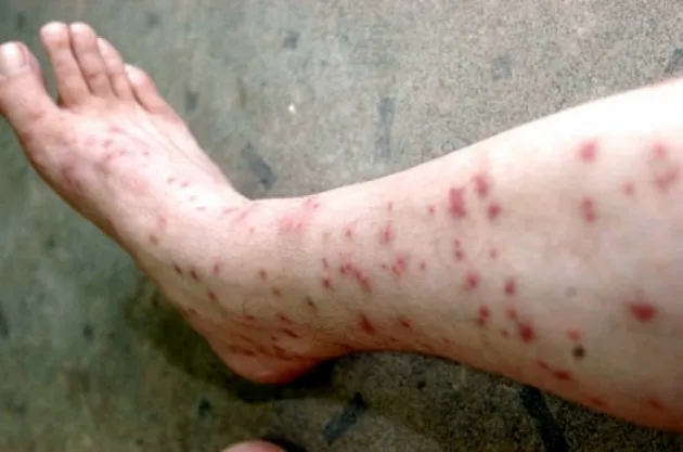 Следы укусов кошачьей блохи на ноге человека